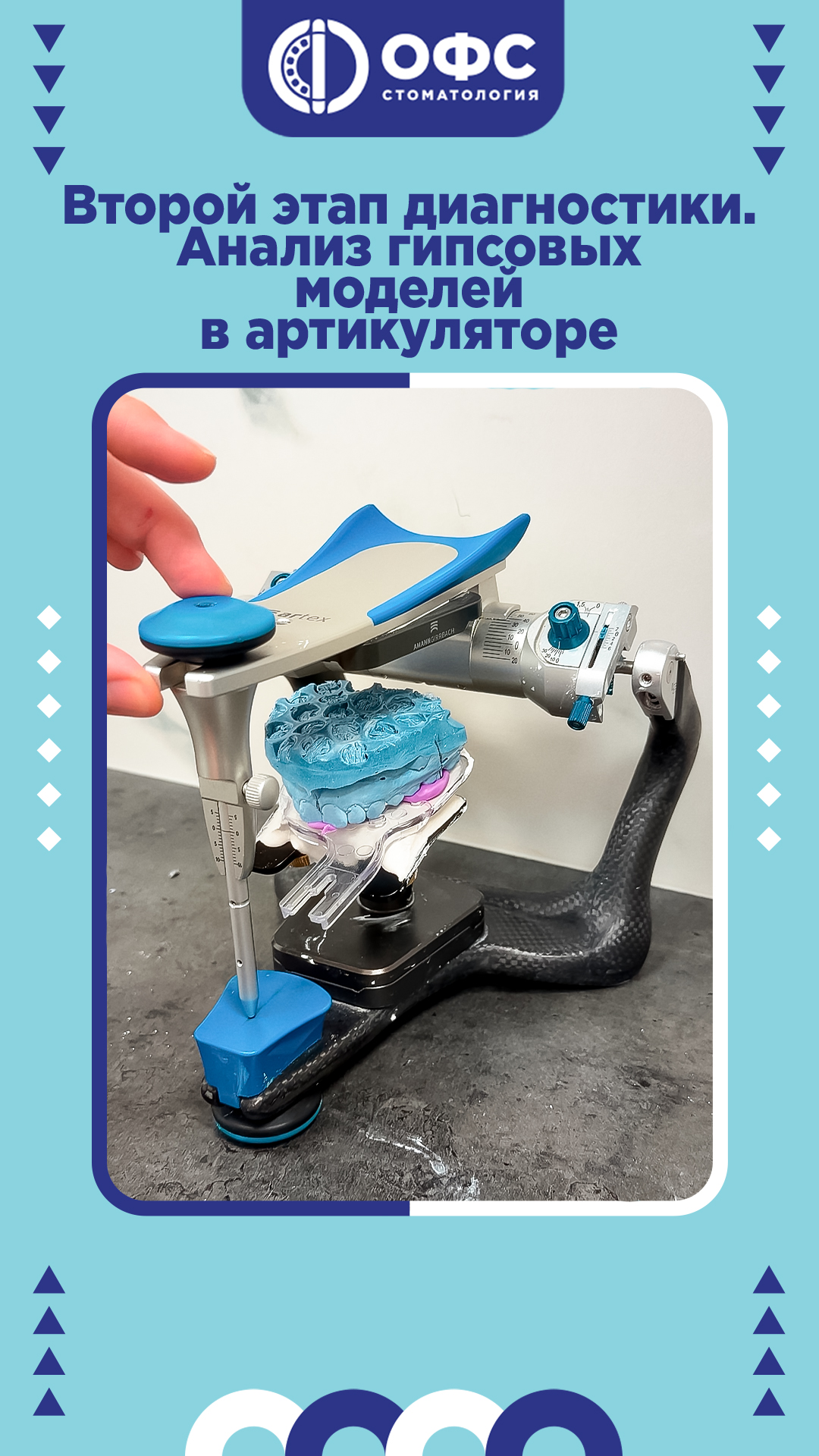 Второй этап диагностики. Анализ гипсовых моделей в артикуляторе.